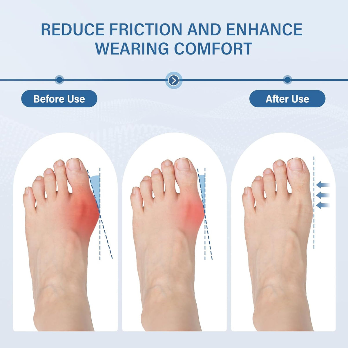 Adjustable hook-and-loop strap on a bunion sleeve
